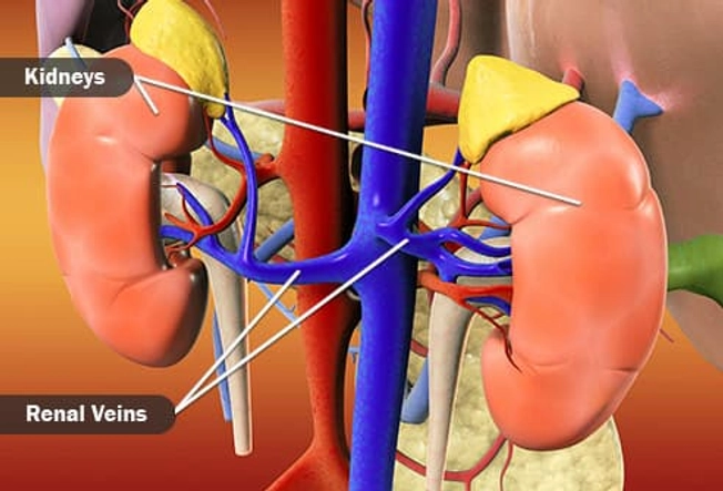 Renal Vein Thrombosis Renal Vein Thrombosis
