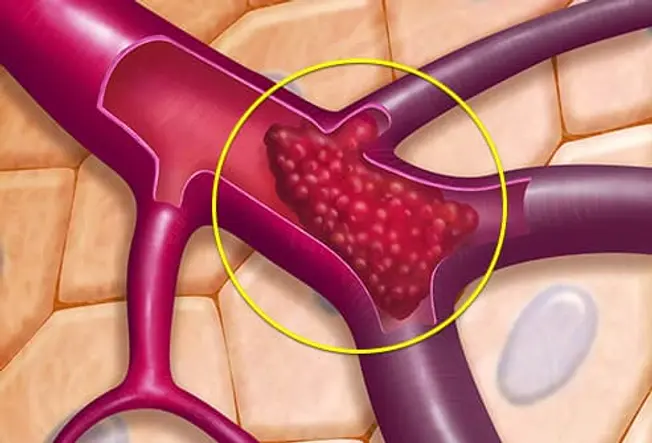 How Thrombosis Starts How Thrombosis Starts