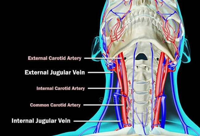 Jugular Vein Thrombosis Jugular Vein Thrombosis