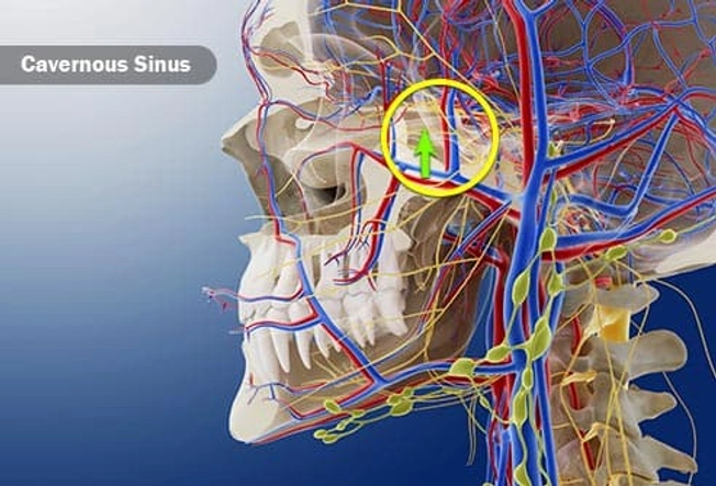 Cavernous Sinus Thrombosis Cavernous Sinus Thrombosis