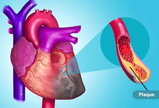 Myocardial Infarction (Heart Attack) Myocardial Infarction (Heart Attack)