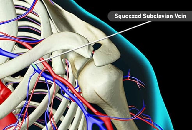 Paget-Schroetter Syndrome (PSS) Paget-Schroetter Syndrome (PSS)