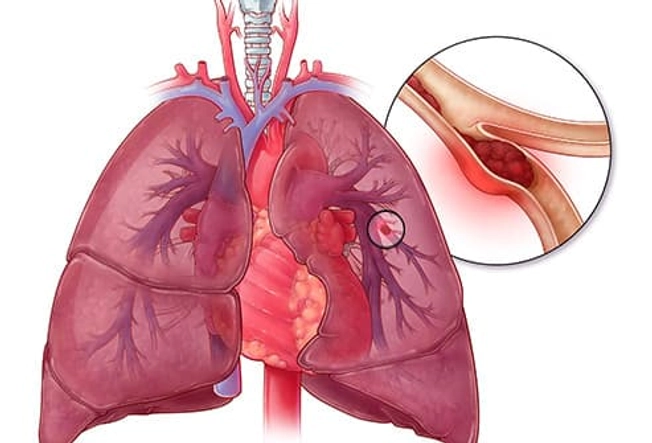 Pulmonary Embolism (PE)
