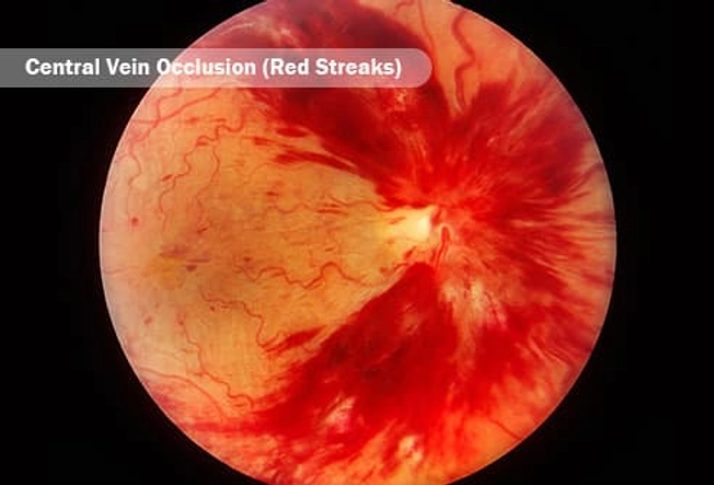 Retinal Vein Occlusion Retinal Vein Occlusion