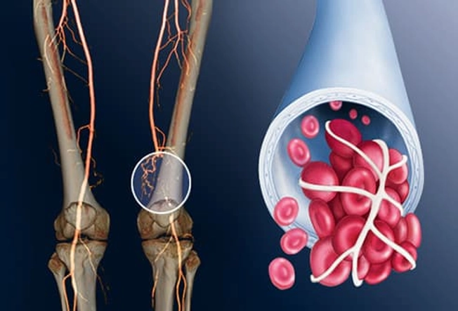 Deep Vein Thrombosis (DVT) Deep Vein Thrombosis (DVT)
