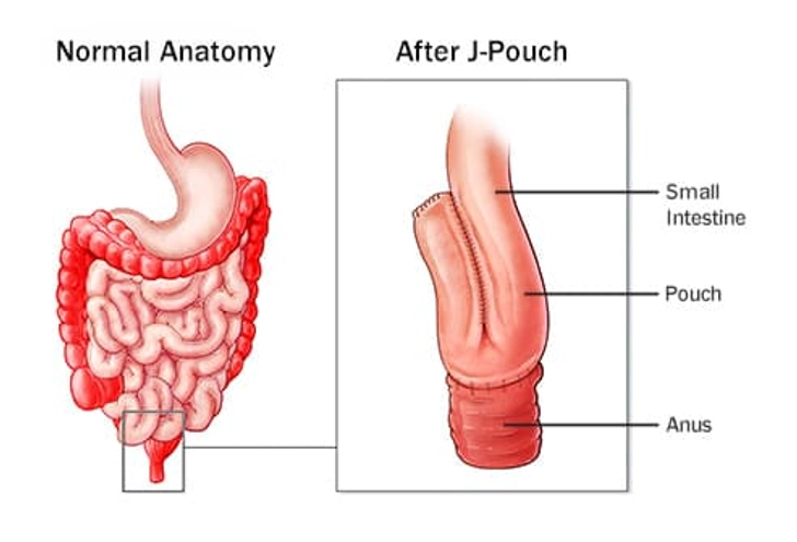 Ileal Pouch Anal Anastomosis: No Bags or Valves Ileal Pouch Anal Anastomosis: No Bags or Valves