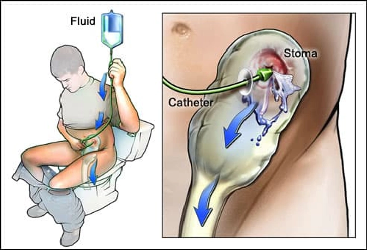 Caring for an Ostomy Bag Caring for an Ostomy Bag