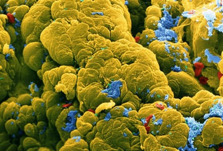 Surgery to Cure UC, Cut Colon Cancer Risk Surgery to Cure UC, Cut Colon Cancer Risk