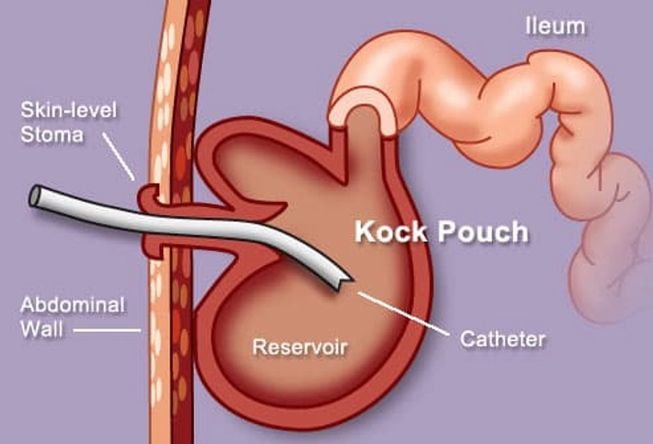Continent Ileostomy: Waste Valve vs. Bag