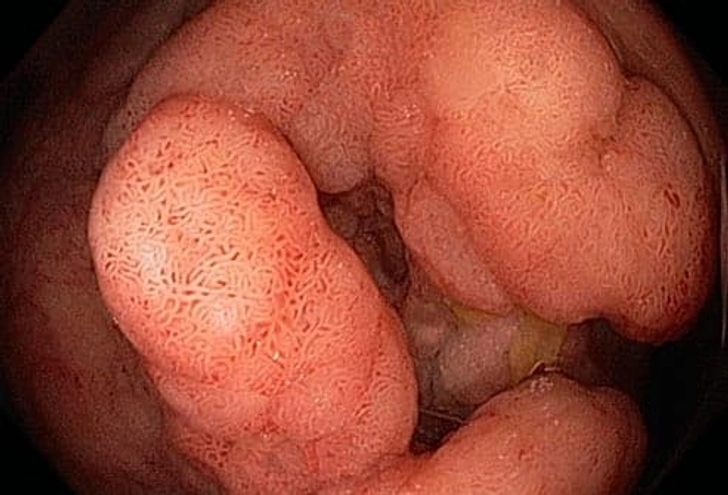 Ulcerative Colitis and Colon Cancer Ulcerative Colitis and Colon Cancer