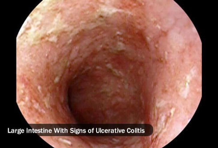 Warning Sign: Abdominal Pain Warning Sign: Abdominal Pain