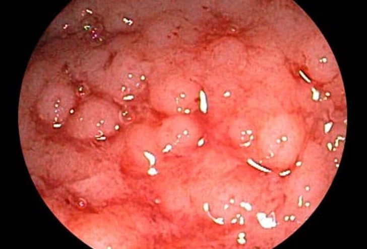 Ulcerative Colitis or Crohn's? Ulcerative Colitis or Crohn's?