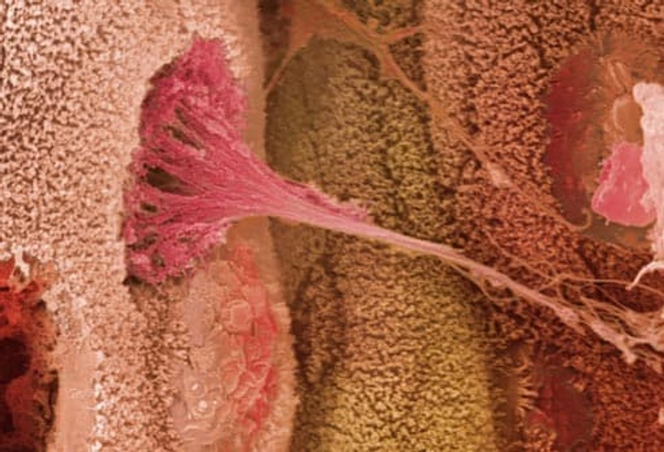 What Causes Ulcerative Colitis? What Causes Ulcerative Colitis?