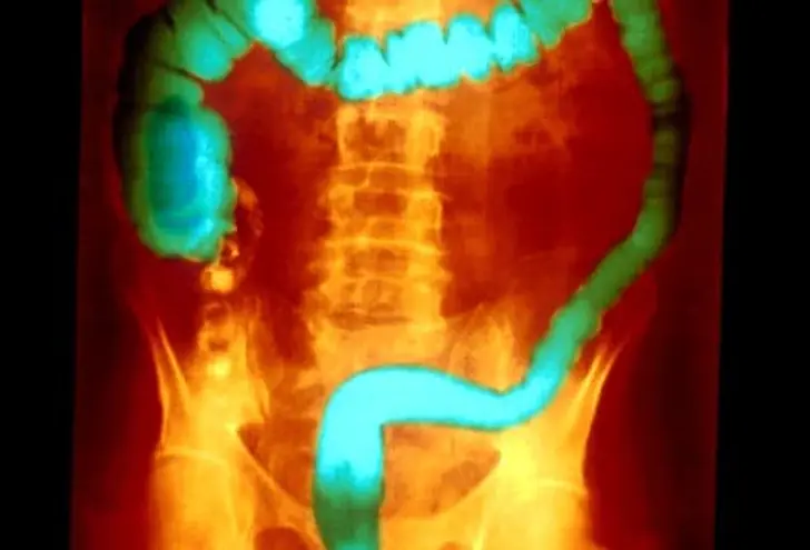 What Is Ulcerative Colitis? What Is Ulcerative Colitis?