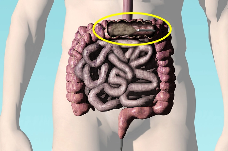 Poop Transplant Poop Transplant