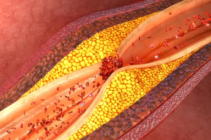 Cholesterol