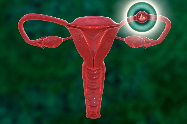 Diagnosis and Treatment of Fallopian Tube Problems