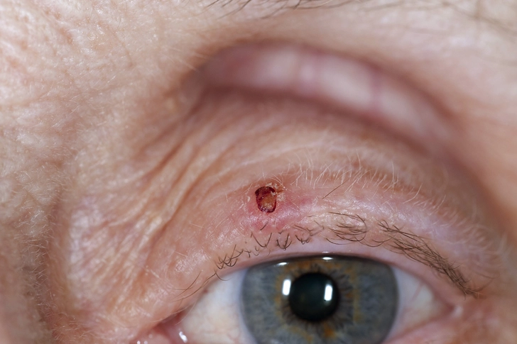 Eyelid Eyelid