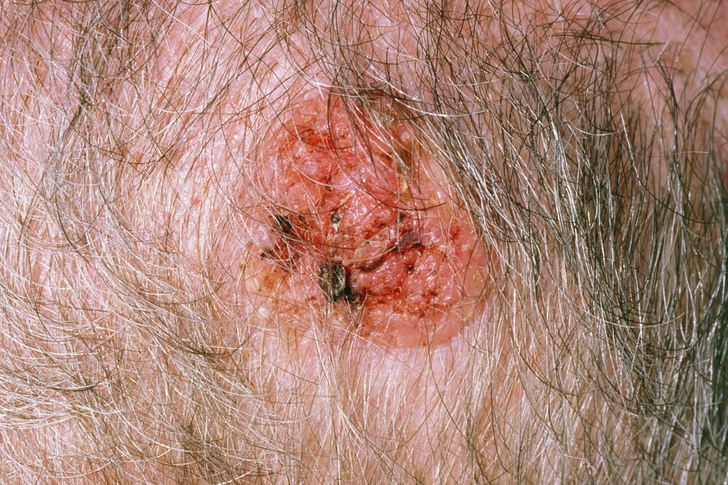 Scalp