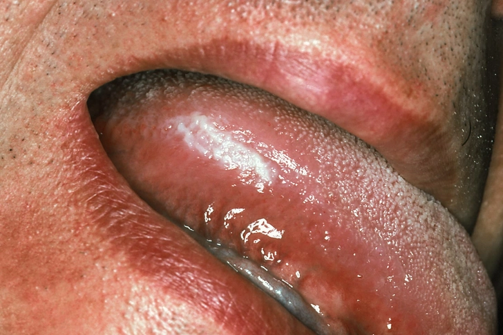 Tongue Tongue