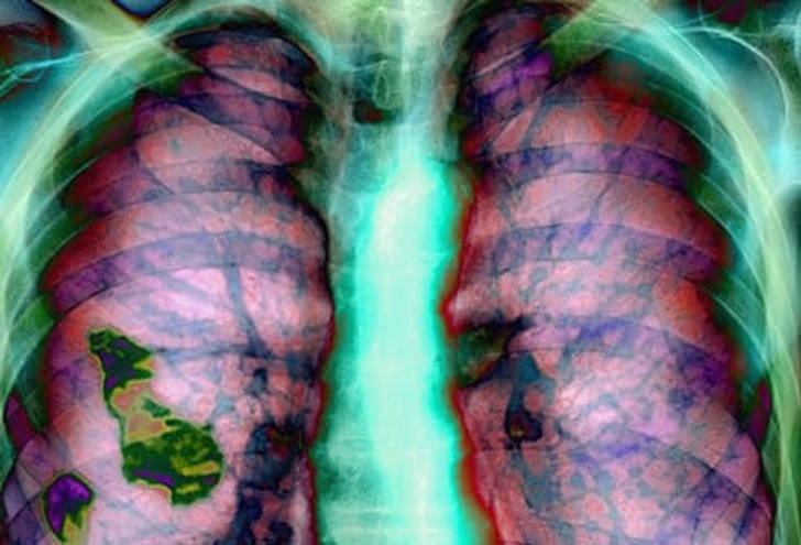 COPD