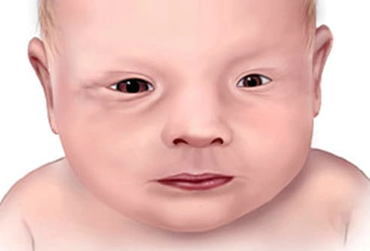 Microphthalmia