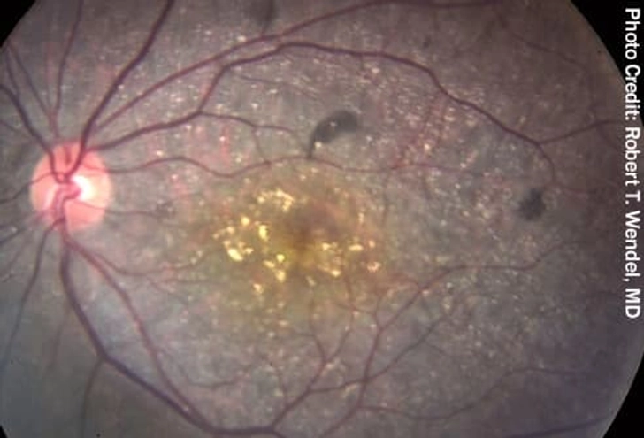 Bietti’s Crystalline Dystrophy (BCD)