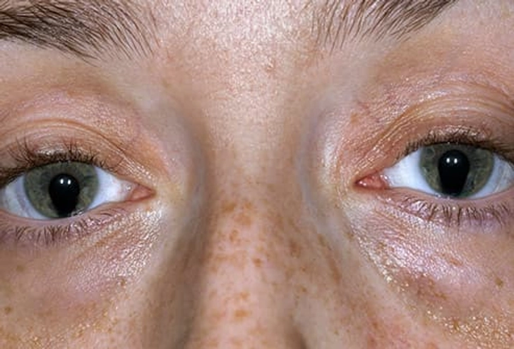 Cat Eye Syndrome
