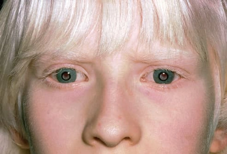 Ocular Albinism