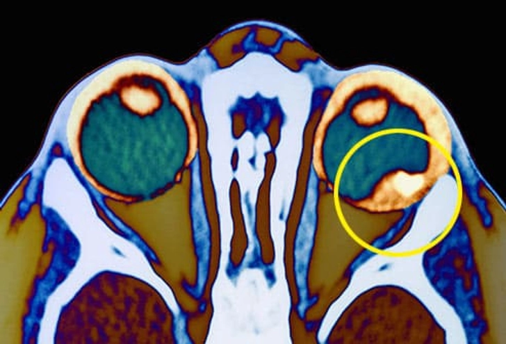 Retinoblastoma