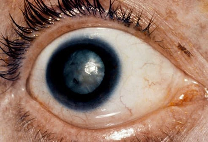 Traumatic Cataract