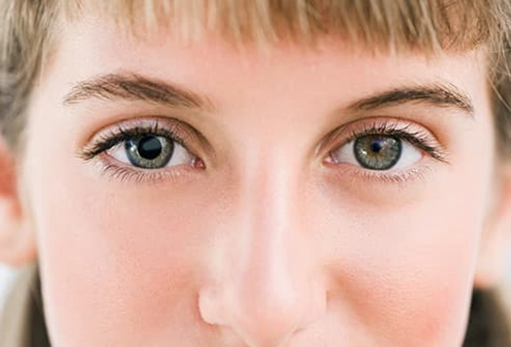 Anisocoria