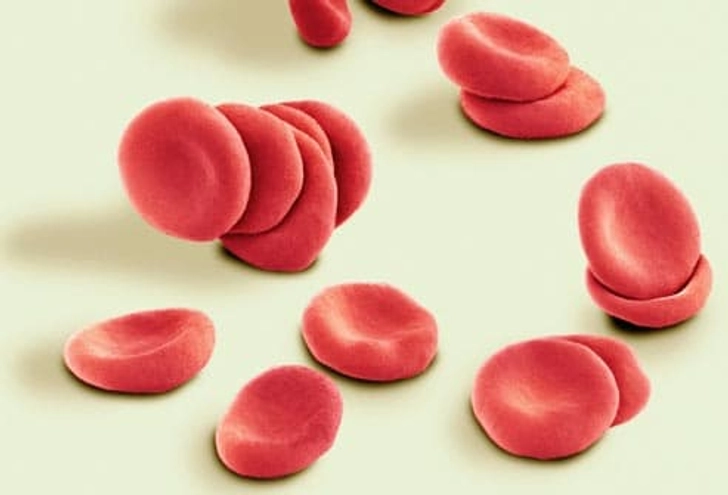 Complications: Fibroids and Anemia Complications: Fibroids and Anemia