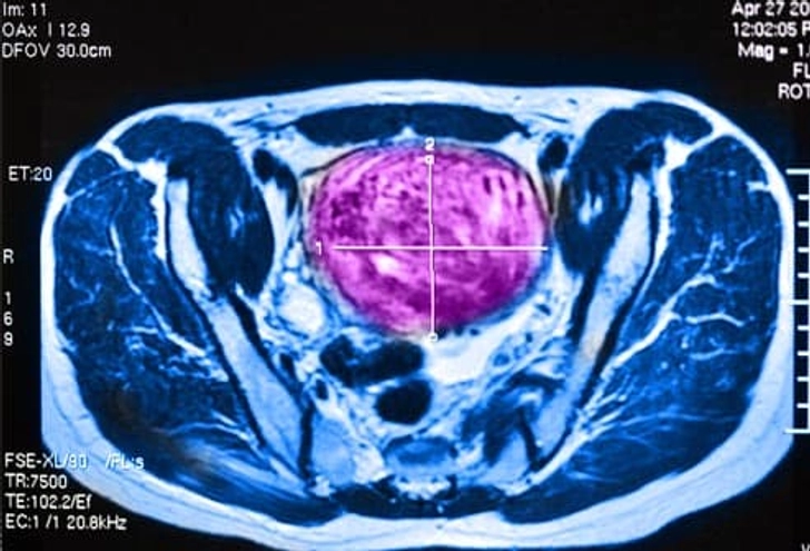 Treatment: Ultrasound