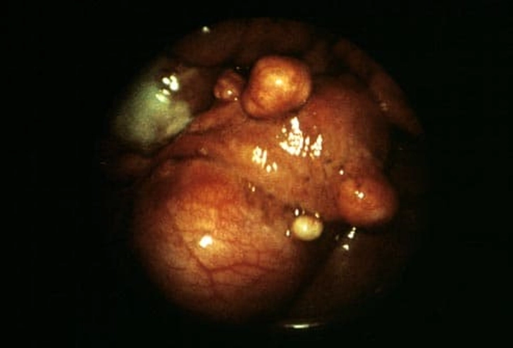 Symptoms of Fibroids: Pressure Symptoms of Fibroids: Pressure