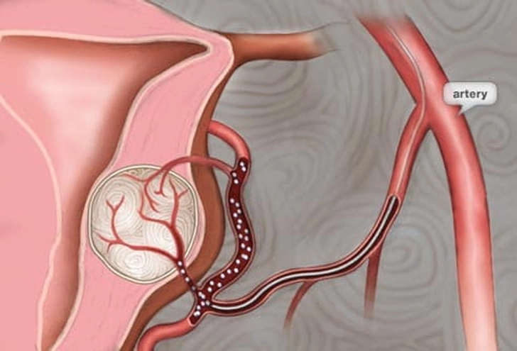 Treatment: Embolization