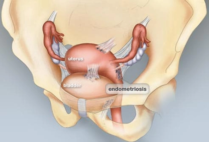 Fibroids or Endometriosis?