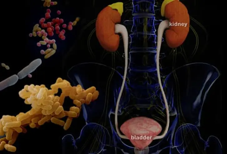 What Is a Urinary Tract Infection? What Is a Urinary Tract Infection?