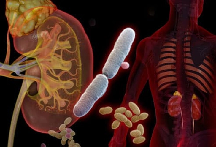 UTI Complications