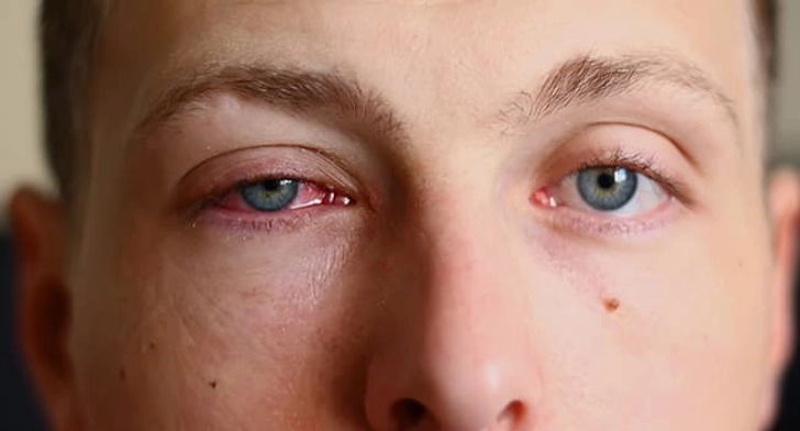 Is It the Same as Pinkeye? Is It the Same as Pinkeye?