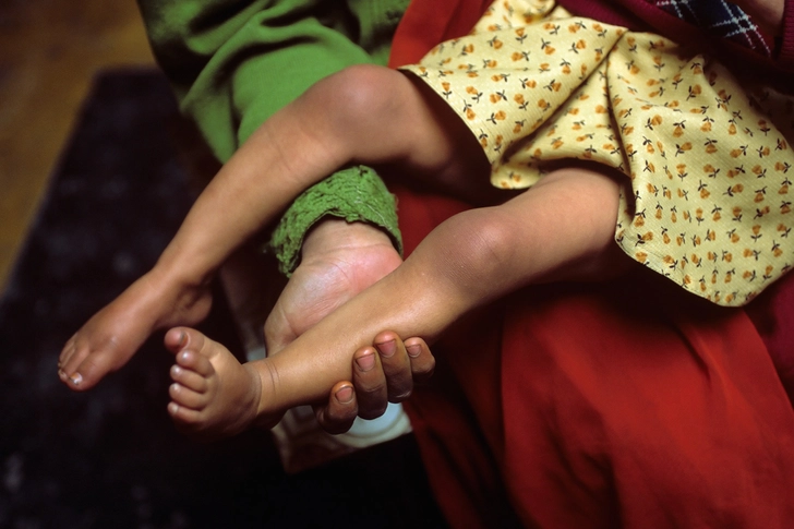 6. Polio