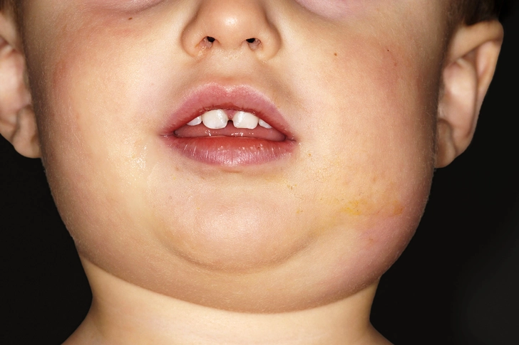 11. Mumps