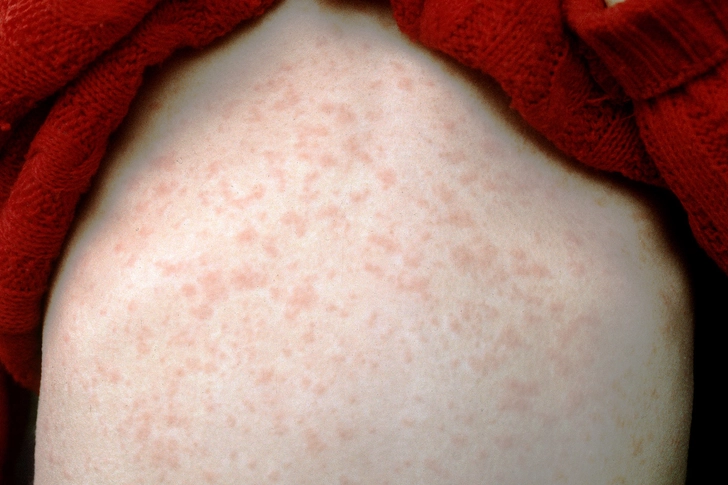 3. Measles