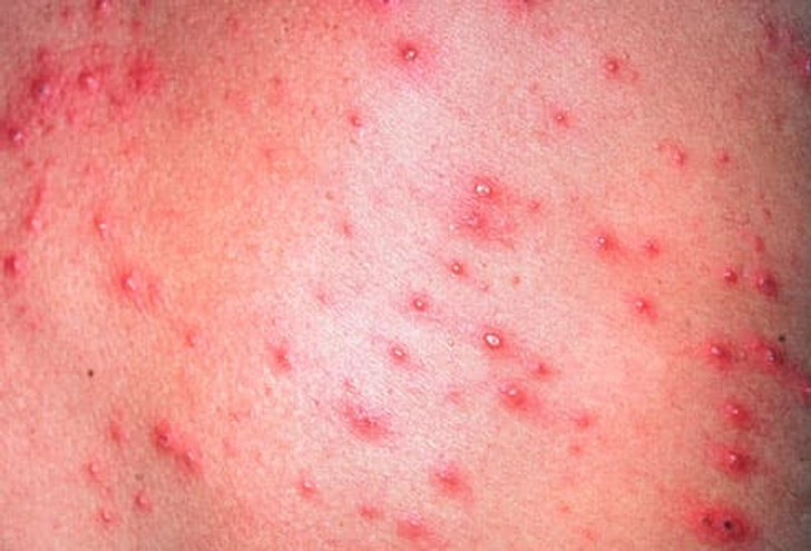 Stay Ahead of Chickenpox Stay Ahead of Chickenpox