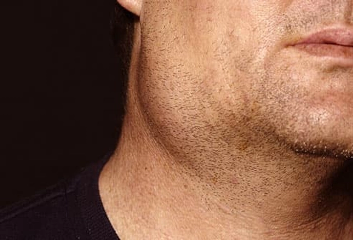 Mumps and Its Complications