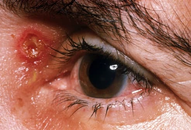 Shingles Vaccine: Important After 60 Shingles Vaccine: Important After 60