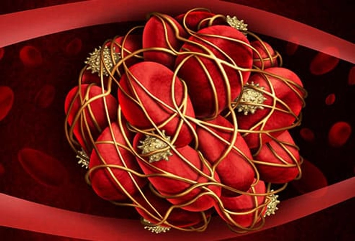 Blood Clots