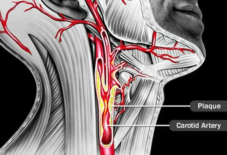 Carotid Artery Disease