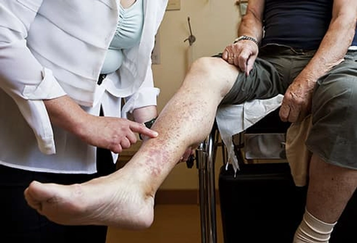Chronic Venous Insufficiency (CVI)