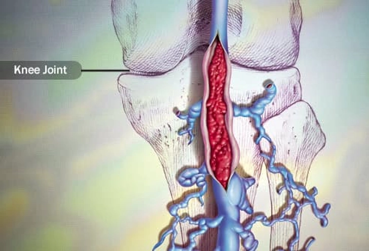 Deep Vein Thrombosis (DVT)